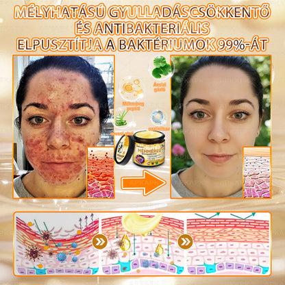 💫APKAPK® 𝐌É𝐇𝐌É𝐑𝐄𝐆 Á𝐓𝐅𝐎𝐆Ó 𝐊𝐑É𝐌𝐀 💛bőrnövedékek 𝐤𝐞𝐳𝐞𝐥é𝐬𝐞 𝐦𝐚𝐠á𝐛𝐚𝐧 𝐟𝐨𝐠𝐥𝐚𝐥𝐣𝐚: é𝐥𝐞𝐭𝐤𝐨𝐫𝐢 𝐟𝐨𝐥𝐭𝐨𝐤, 𝐡𝐞𝐠𝐞𝐤, 𝐬𝐳𝐞𝐦ö𝐥𝐜𝐬ö𝐤, 𝐛ö𝐫𝐧ö𝐯𝐞𝐝é𝐤𝐞𝐤, 𝐭á𝐥𝐲𝐨𝐠𝐨𝐤, 𝐩𝐚𝐭𝐭𝐚𝐧á𝐬𝐨𝐤, 𝐞𝐤𝐜é𝐦𝐚, 𝐩𝐬𝐨𝐫𝐢𝐚𝐬𝐢𝐬, 𝐚𝐜𝐧𝐞 𝐢𝐧𝐯𝐞𝐫𝐬𝐚, 𝐫á𝐧𝐜𝐨𝐤, 𝐛ö𝐫ö𝐫𝐞𝐠𝐞𝐝é𝐬 é𝐬 𝐞𝐠𝐲é𝐛 𝐩𝐫𝐨𝐛𝐥é𝐦á𝐤🔥