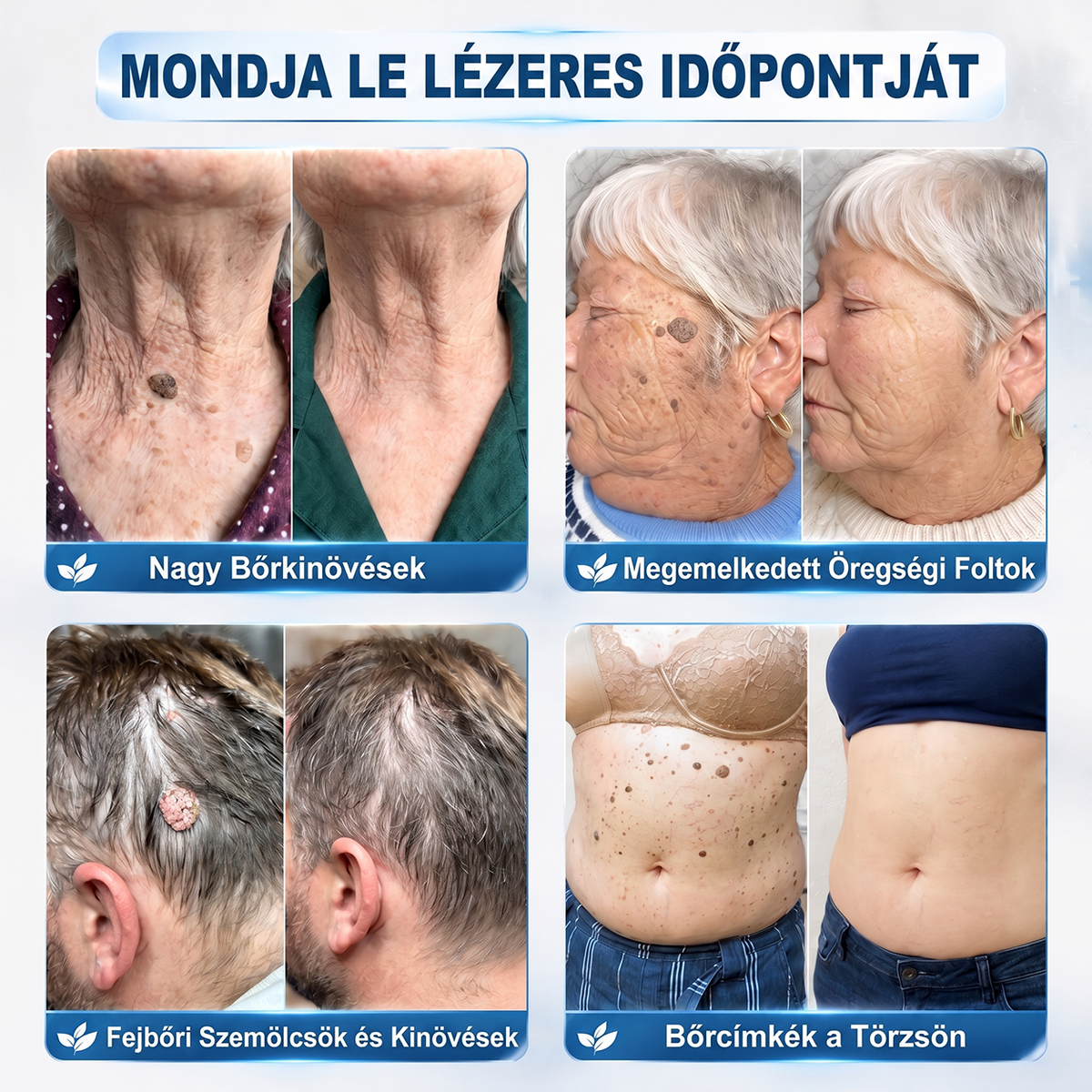 Hivatalos Márkabolt | Hiskin® 7 napos Szemölcseltávolító Roll-on Ápoló Folyadék (Fájdalommentes rollerball technológia, hegek nélkül)