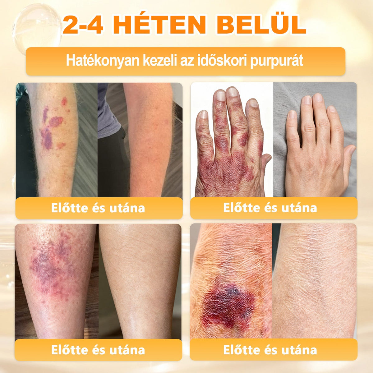 💜APKAPK® 𝐌É𝐇𝐌É𝐑𝐄𝐆 Á𝐓𝐅𝐎𝐆Ó 𝐊𝐑É𝐌𝐀 💛bőrnövedékek 𝐤𝐞𝐳𝐞𝐥é𝐬𝐞 𝐦𝐚𝐠á𝐛𝐚𝐧 𝐟𝐨𝐠𝐥𝐚𝐥𝐣𝐚: é𝐥𝐞𝐭𝐤𝐨𝐫𝐢 𝐟𝐨𝐥𝐭𝐨𝐤, 𝐡𝐞𝐠𝐞𝐤, 𝐬𝐳𝐞𝐦ö𝐥𝐜𝐬ö𝐤, 𝐛ö𝐫𝐧ö𝐯𝐞𝐝é𝐤𝐞𝐤, 𝐭á𝐥𝐲𝐨𝐠𝐨𝐤, 𝐩𝐚𝐭𝐭𝐚𝐧á𝐬𝐨𝐤, 𝐞𝐤𝐜é𝐦𝐚, 𝐩𝐬𝐨𝐫𝐢𝐚𝐬𝐢𝐬, 𝐚𝐜𝐧𝐞 𝐢𝐧𝐯𝐞𝐫𝐬𝐚, 𝐫á𝐧𝐜𝐨𝐤, 𝐛ö𝐫ö𝐫𝐞𝐠𝐞𝐝é𝐬 é𝐬 𝐞𝐠𝐲é𝐛 𝐩𝐫𝐨𝐛𝐥é𝐦á𝐤🔥