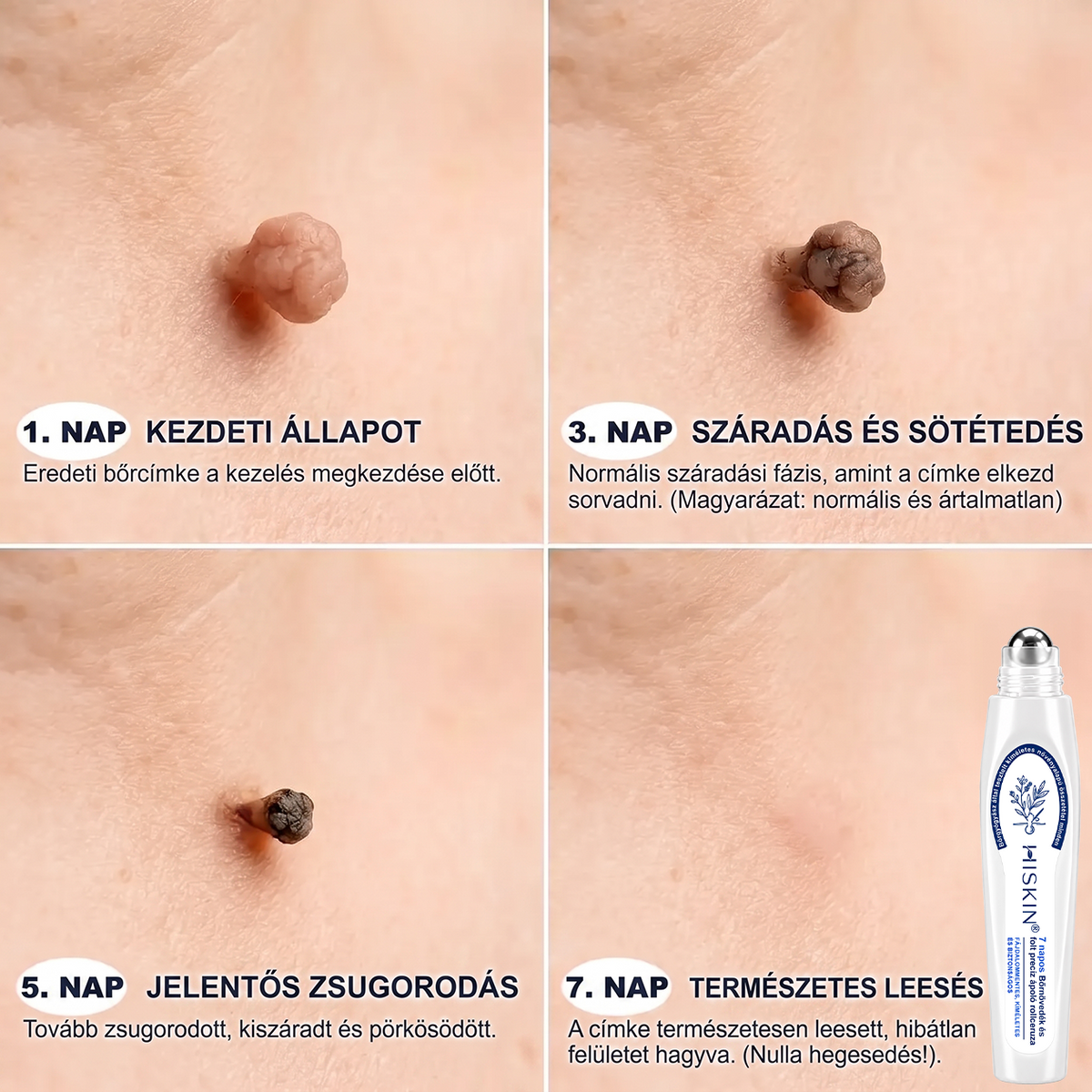 Hivatalos Márkabolt | Hiskin® 7 napos Szemölcseltávolító Roll-on Ápoló Folyadék (Fájdalommentes rollerball technológia, hegek nélkül)