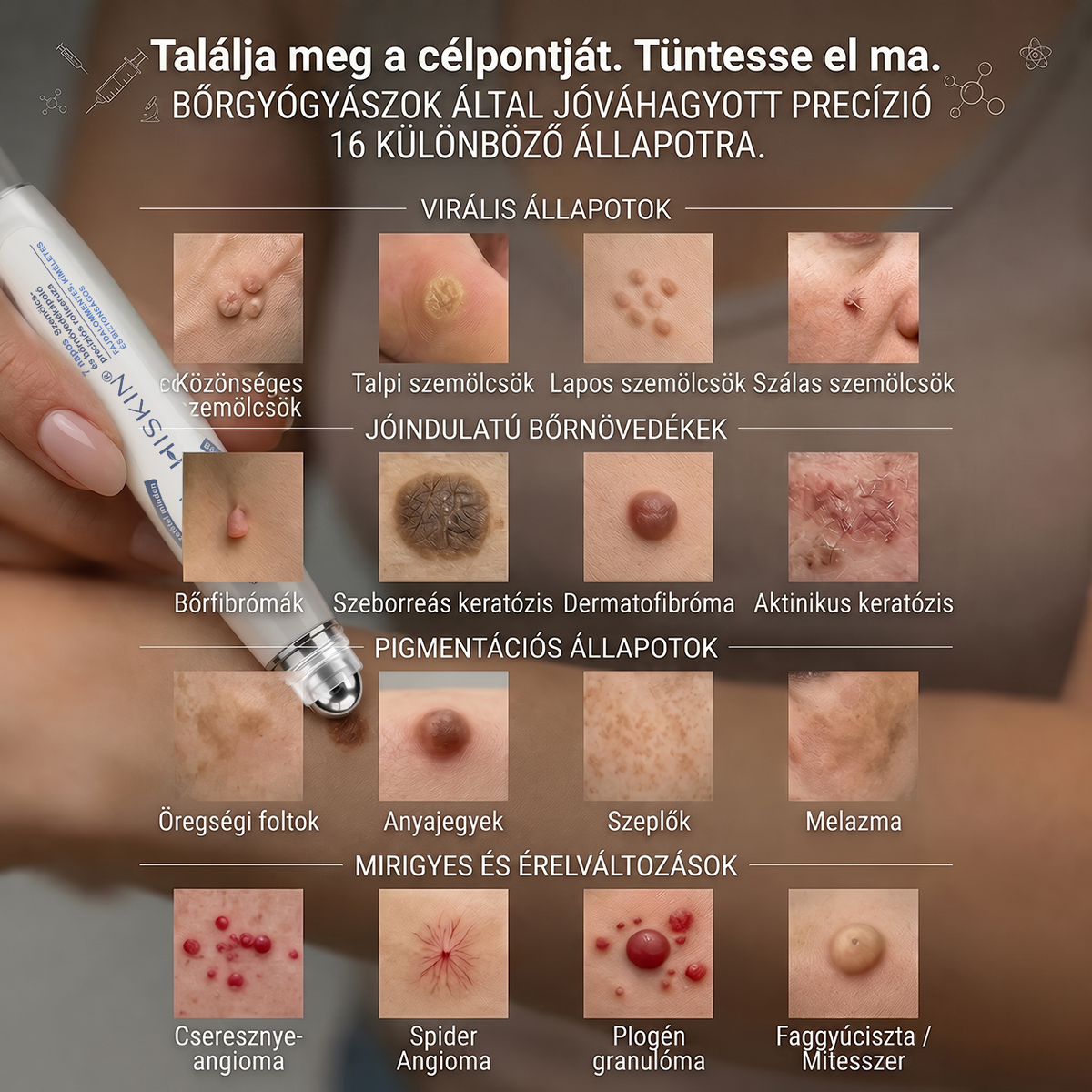 Hivatalos Márkabolt | Hiskin® 7 napos Szemölcseltávolító Roll-on Ápoló Folyadék (Fájdalommentes rollerball technológia, hegek nélkül)