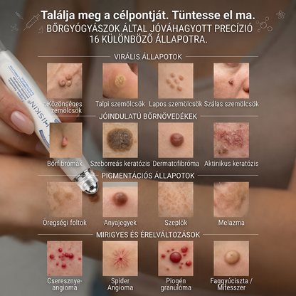 Hivatalos Márkabolt | Hiskin® 7 napos Szemölcseltávolító Roll-on Ápoló Folyadék (Fájdalommentes rollerball technológia, hegek nélkül)