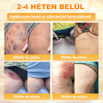 💫APKAPK® 𝐌É𝐇𝐌É𝐑𝐄𝐆 Á𝐓𝐅𝐎𝐆Ó 𝐊𝐑É𝐌𝐀 💛bőrnövedékek 𝐤𝐞𝐳𝐞𝐥é𝐬𝐞 𝐦𝐚𝐠á𝐛𝐚𝐧 𝐟𝐨𝐠𝐥𝐚𝐥𝐣𝐚: é𝐥𝐞𝐭𝐤𝐨𝐫𝐢 𝐟𝐨𝐥𝐭𝐨𝐤, 𝐡𝐞𝐠𝐞𝐤, 𝐬𝐳𝐞𝐦ö𝐥𝐜𝐬ö𝐤, 𝐛ö𝐫𝐧ö𝐯𝐞𝐝é𝐤𝐞𝐤, 𝐭á𝐥𝐲𝐨𝐠𝐨𝐤, 𝐩𝐚𝐭𝐭𝐚𝐧á𝐬𝐨𝐤, 𝐞𝐤𝐜é𝐦𝐚, 𝐩𝐬𝐨𝐫𝐢𝐚𝐬𝐢𝐬, 𝐚𝐜𝐧𝐞 𝐢𝐧𝐯𝐞𝐫𝐬𝐚, 𝐫á𝐧𝐜𝐨𝐤, 𝐛ö𝐫ö𝐫𝐞𝐠𝐞𝐝é𝐬 é𝐬 𝐞𝐠𝐲é𝐛 𝐩𝐫𝐨𝐛𝐥é𝐦á𝐤🔥