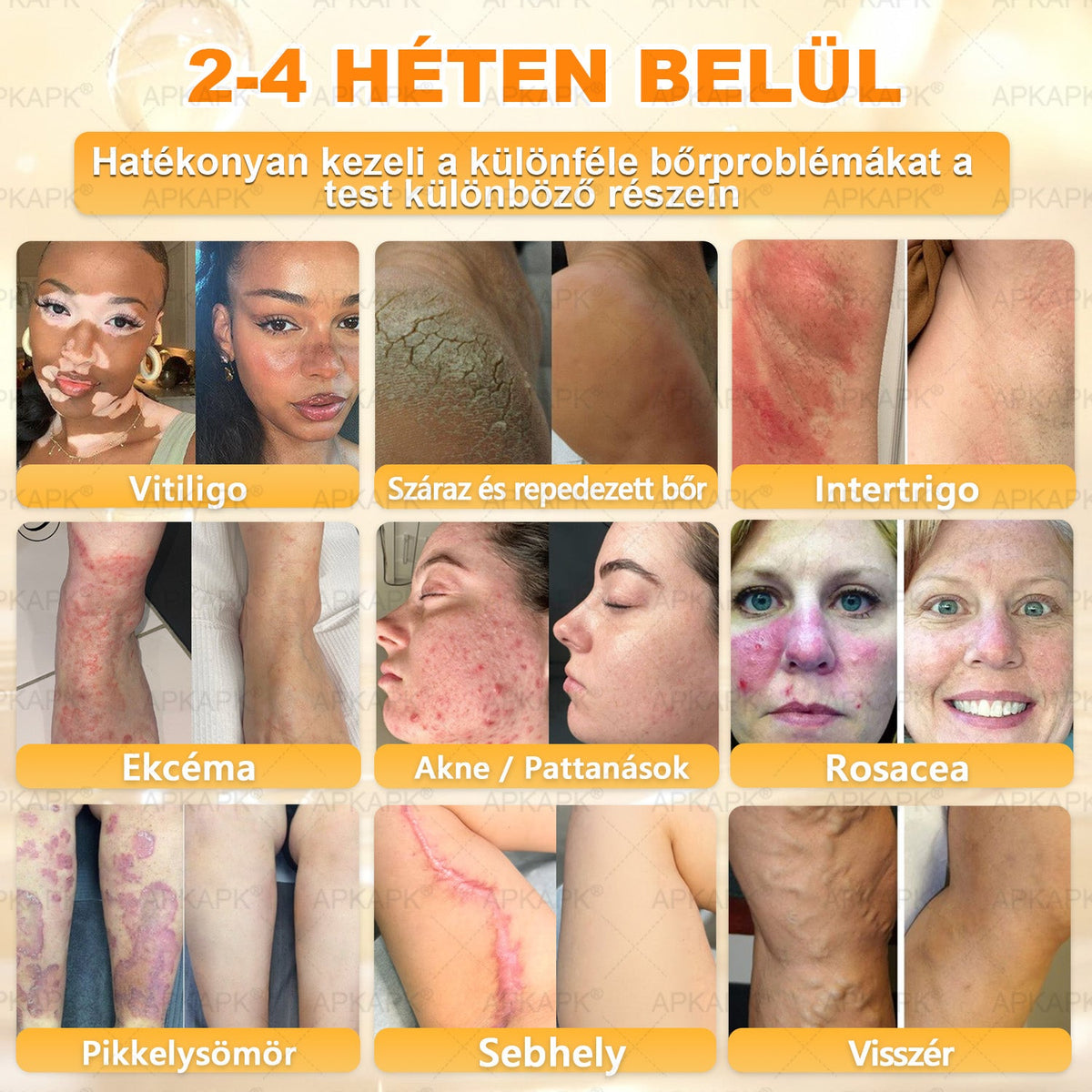 💫APKAPK® 𝐌É𝐇𝐌É𝐑𝐄𝐆 Á𝐓𝐅𝐎𝐆Ó 𝐊𝐑É𝐌𝐀 💛bőrnövedékek 𝐤𝐞𝐳𝐞𝐥é𝐬𝐞 𝐦𝐚𝐠á𝐛𝐚𝐧 𝐟𝐨𝐠𝐥𝐚𝐥𝐣𝐚: é𝐥𝐞𝐭𝐤𝐨𝐫𝐢 𝐟𝐨𝐥𝐭𝐨𝐤, 𝐡𝐞𝐠𝐞𝐤, 𝐬𝐳𝐞𝐦ö𝐥𝐜𝐬ö𝐤, 𝐛ö𝐫𝐧ö𝐯𝐞𝐝é𝐤𝐞𝐤, 𝐭á𝐥𝐲𝐨𝐠𝐨𝐤, 𝐩𝐚𝐭𝐭𝐚𝐧á𝐬𝐨𝐤, 𝐞𝐤𝐜é𝐦𝐚, 𝐩𝐬𝐨𝐫𝐢𝐚𝐬𝐢𝐬, 𝐚𝐜𝐧𝐞 𝐢𝐧𝐯𝐞𝐫𝐬𝐚, 𝐫á𝐧𝐜𝐨𝐤, 𝐛ö𝐫ö𝐫𝐞𝐠𝐞𝐝é𝐬 é𝐬 𝐞𝐠𝐲é𝐛 𝐩𝐫𝐨𝐛𝐥é𝐦á𝐤🔥