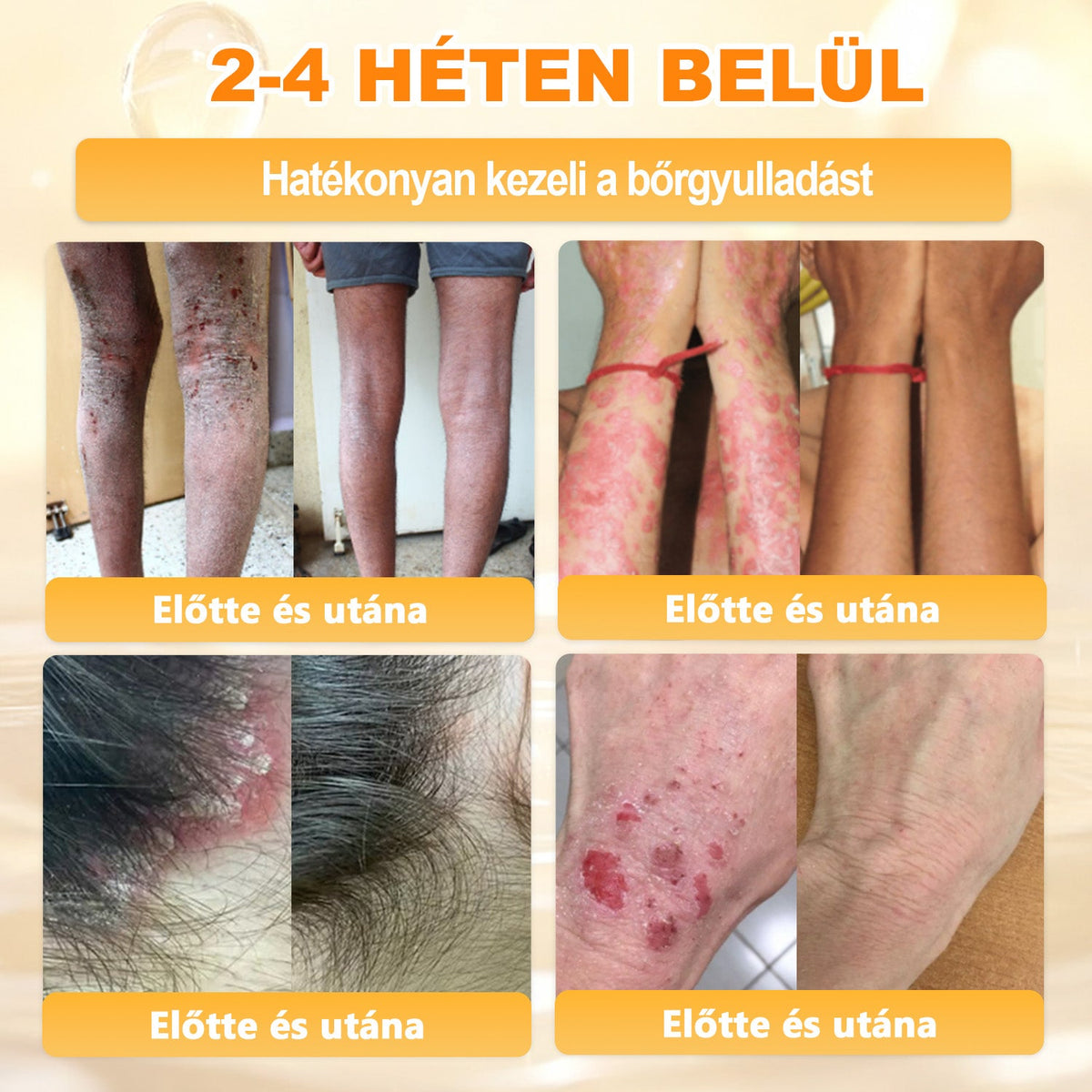 💫APKAPK® 𝐌É𝐇𝐌É𝐑𝐄𝐆 Á𝐓𝐅𝐎𝐆Ó 𝐊𝐑É𝐌𝐀 💛bőrnövedékek 𝐤𝐞𝐳𝐞𝐥é𝐬𝐞 𝐦𝐚𝐠á𝐛𝐚𝐧 𝐟𝐨𝐠𝐥𝐚𝐥𝐣𝐚: é𝐥𝐞𝐭𝐤𝐨𝐫𝐢 𝐟𝐨𝐥𝐭𝐨𝐤, 𝐡𝐞𝐠𝐞𝐤, 𝐬𝐳𝐞𝐦ö𝐥𝐜𝐬ö𝐤, 𝐛ö𝐫𝐧ö𝐯𝐞𝐝é𝐤𝐞𝐤, 𝐭á𝐥𝐲𝐨𝐠𝐨𝐤, 𝐩𝐚𝐭𝐭𝐚𝐧á𝐬𝐨𝐤, 𝐞𝐤𝐜é𝐦𝐚, 𝐩𝐬𝐨𝐫𝐢𝐚𝐬𝐢𝐬, 𝐚𝐜𝐧𝐞 𝐢𝐧𝐯𝐞𝐫𝐬𝐚, 𝐫á𝐧𝐜𝐨𝐤, 𝐛ö𝐫ö𝐫𝐞𝐠𝐞𝐝é𝐬 é𝐬 𝐞𝐠𝐲é𝐛 𝐩𝐫𝐨𝐛𝐥é𝐦á𝐤🔥