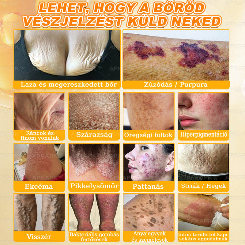 💫APKAPK® 𝐌É𝐇𝐌É𝐑𝐄𝐆 Á𝐓𝐅𝐎𝐆Ó 𝐊𝐑É𝐌𝐀 💛bőrnövedékek 𝐤𝐞𝐳𝐞𝐥é𝐬𝐞 𝐦𝐚𝐠á𝐛𝐚𝐧 𝐟𝐨𝐠𝐥𝐚𝐥𝐣𝐚: é𝐥𝐞𝐭𝐤𝐨𝐫𝐢 𝐟𝐨𝐥𝐭𝐨𝐤, 𝐡𝐞𝐠𝐞𝐤, 𝐬𝐳𝐞𝐦ö𝐥𝐜𝐬ö𝐤, 𝐛ö𝐫𝐧ö𝐯𝐞𝐝é𝐤𝐞𝐤, 𝐭á𝐥𝐲𝐨𝐠𝐨𝐤, 𝐩𝐚𝐭𝐭𝐚𝐧á𝐬𝐨𝐤, 𝐞𝐤𝐜é𝐦𝐚, 𝐩𝐬𝐨𝐫𝐢𝐚𝐬𝐢𝐬, 𝐚𝐜𝐧𝐞 𝐢𝐧𝐯𝐞𝐫𝐬𝐚, 𝐫á𝐧𝐜𝐨𝐤, 𝐛ö𝐫ö𝐫𝐞𝐠𝐞𝐝é𝐬 é𝐬 𝐞𝐠𝐲é𝐛 𝐩𝐫𝐨𝐛𝐥é𝐦á𝐤🔥